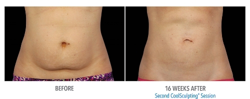 āļāļĨāļāđāļāļ-āļŦāļĨāļąāļ CoolSculpting āļāļĢāļīāđāļ§āļāļŦāļāđāļēāļāđāļāļ