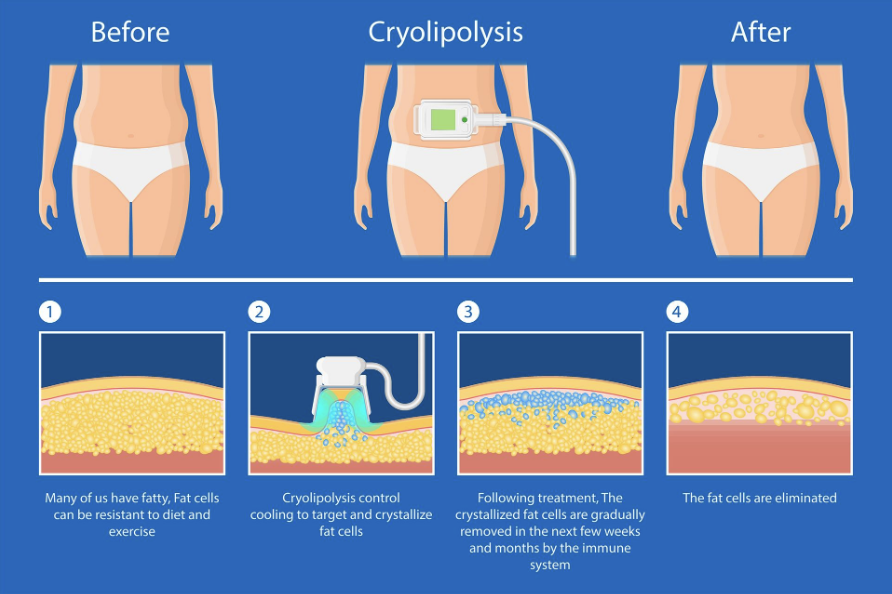 āļāļąāđāļāļāļāļ Cryolipolysis - āļāļĢāļ°āļāļ§āļāļāļēāļĢ CoolSculpting